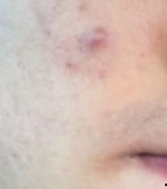 网红的痘痘怎样处理,告别瑕疵，焕发自信光彩